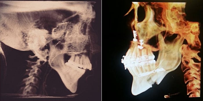 X-rays show Crooks' jaw before and after surgery. (Lana Crooks)