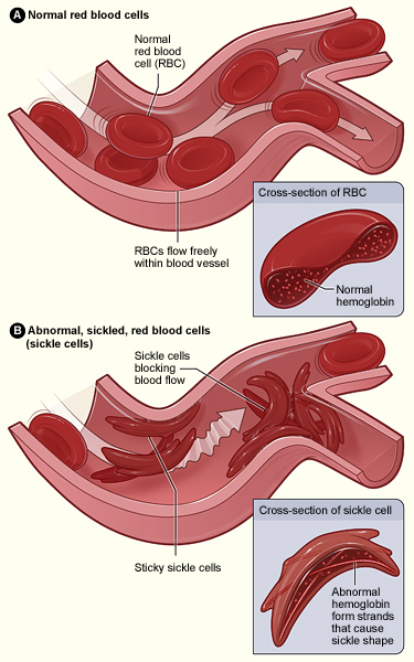 "Sickle cell 01" by The National Heart, Lung, and Blood Institute (NHLBI) 