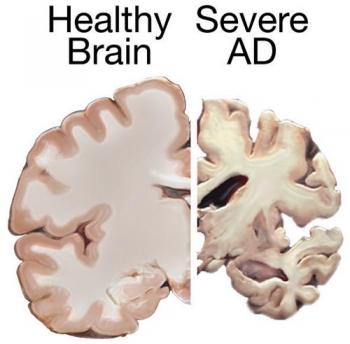 A healthy brain compared to a brain suffering from Alzheimer's Disease; photo by National Institutes of Health