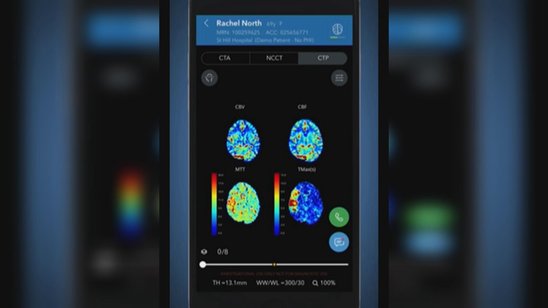 The AI-powered Viz.ai software analyzes brain scans by using an algorithm and deep learning. (Courtesy: Viz.ai, Inc.)