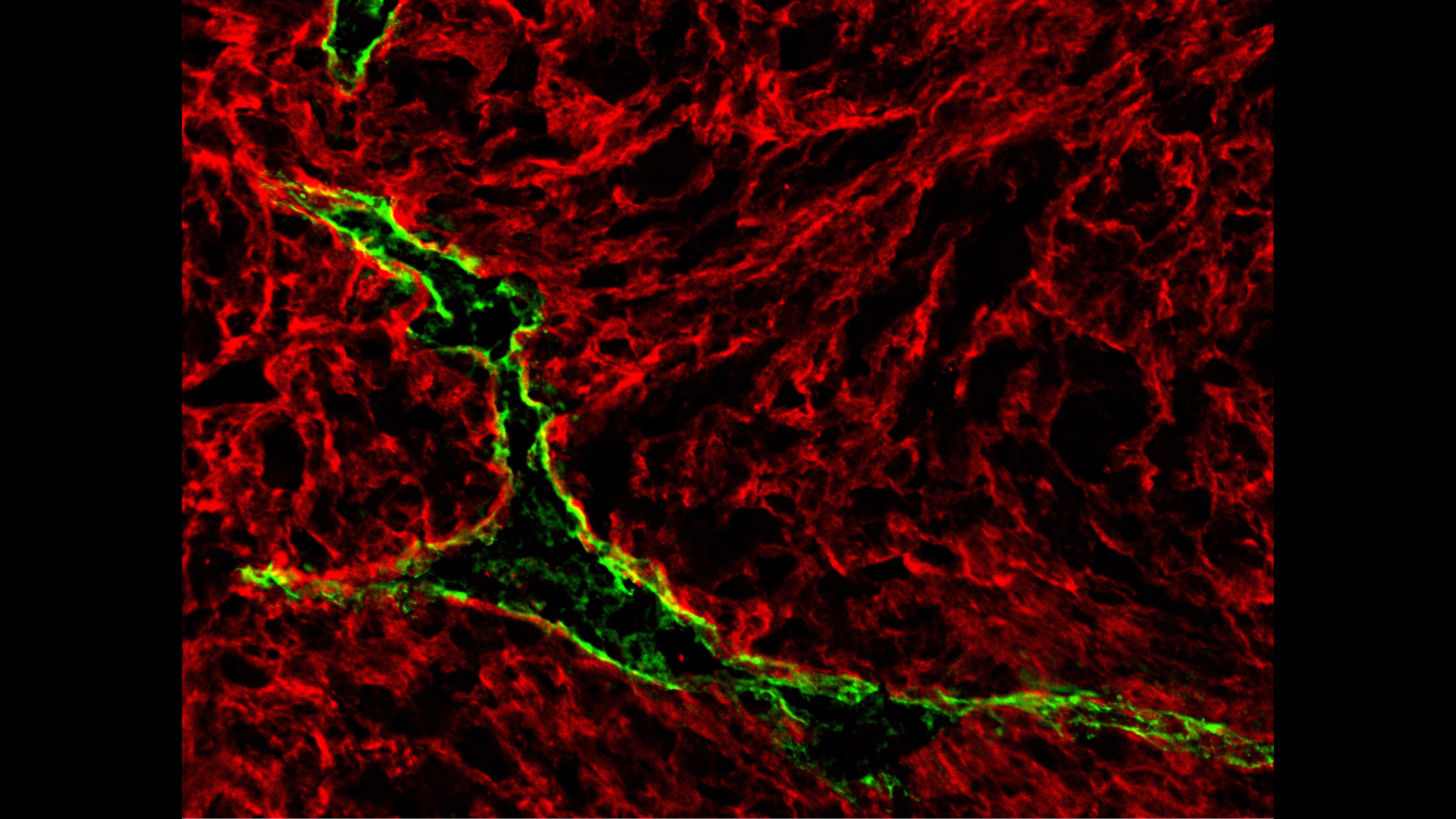 A lymphatic vessel (green) inside a Braf-driven primary mouse melanoma tumor. (Manuel Fankhauser and Maria Broggi / EPFL)